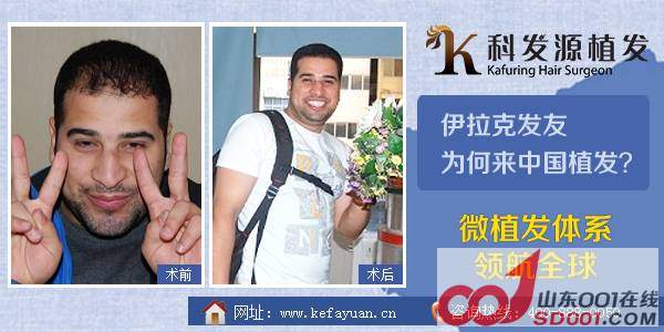 <em>种头发有危害吗</em>?科发源权威解答-济南-发际线